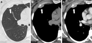 Imaging Characteristics Of Pleural Tumours Springerlink