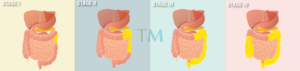 Mesothelioma Stages Four Stages Three Staging Systems