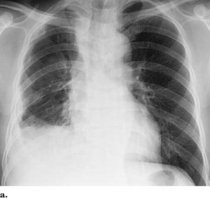 Malignant Mesothelioma In A 51 Year Old Man A Chest Radiograph Shows Download Scientific Diagram