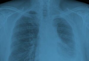 Mesothelioma Asbestos Related Cancers Prim Law Firm