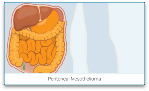 Peritoneal Mesothelioma Best 3 Treatment Options