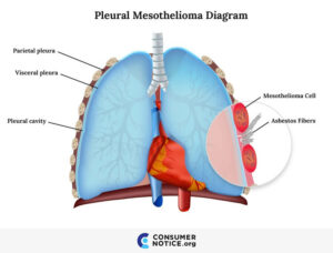 Asbestos And Mesothelioma Symptoms Stages Treatments